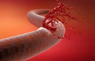 Тромбоз лучевой артерии после коронарографии (лечение)